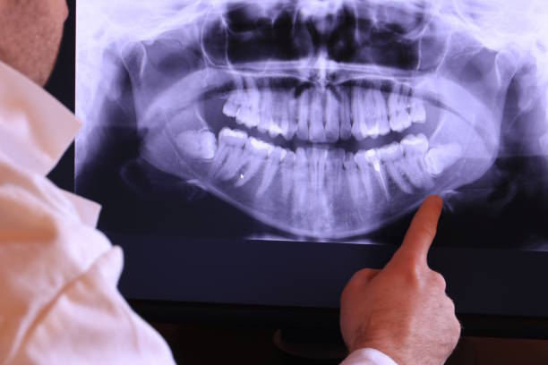 Best Emergency Root Canal Treatment in Montgomery Village, MD