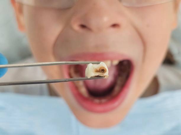 Best Emergency Treatment for Toothache in Montgomery Village, MD